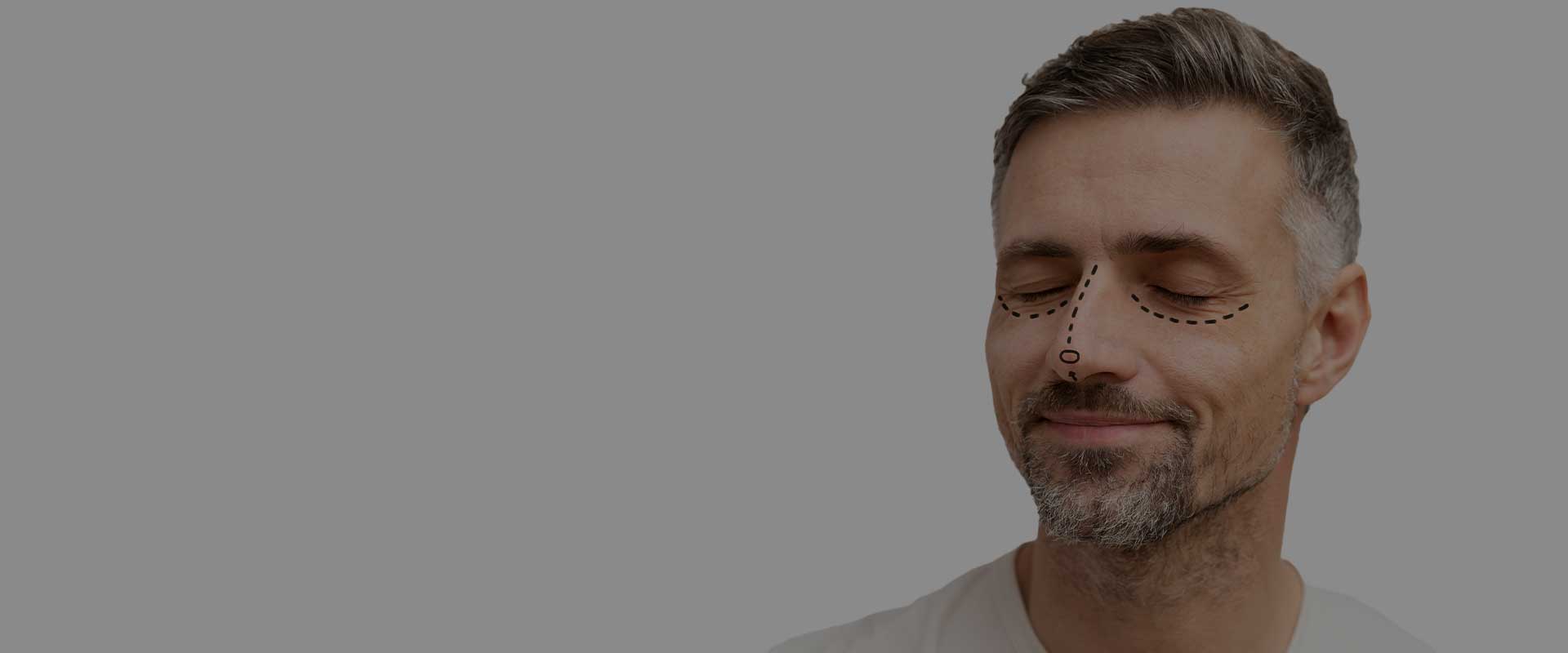 RHINOPLASTY