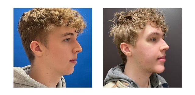 0701a52-5cf-5b4d-e1da-d05d0e560704_Drew_-_Jaw_Surgery_