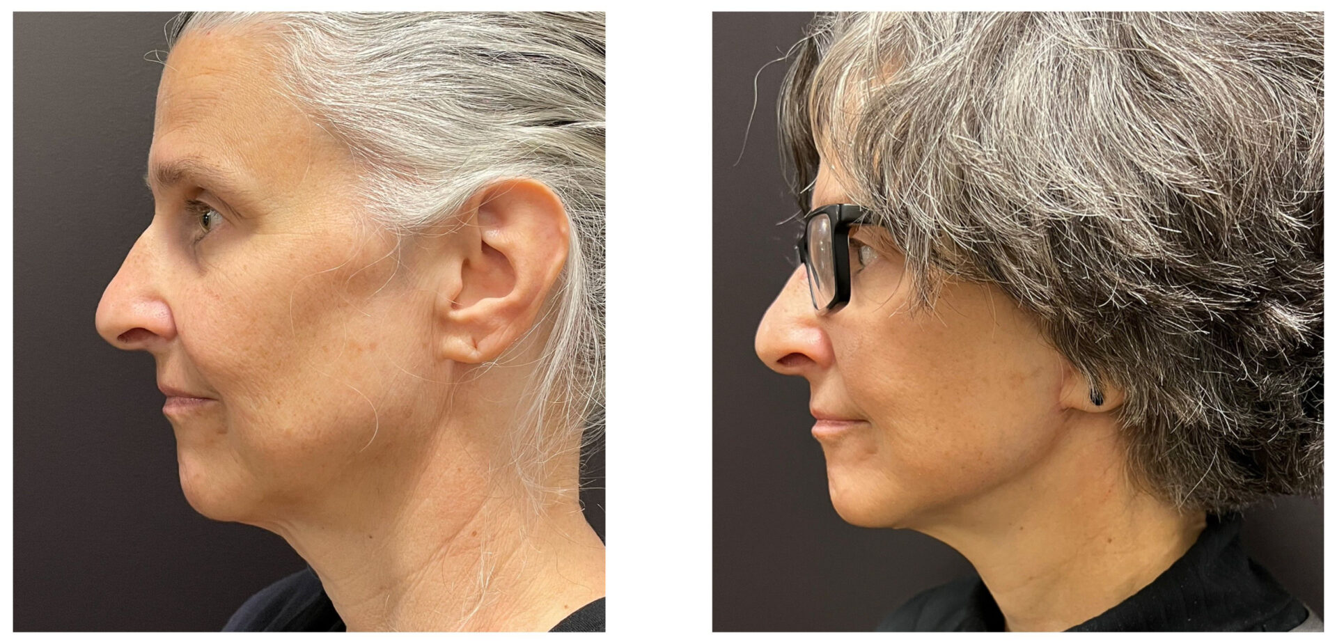Facelift - Before & After