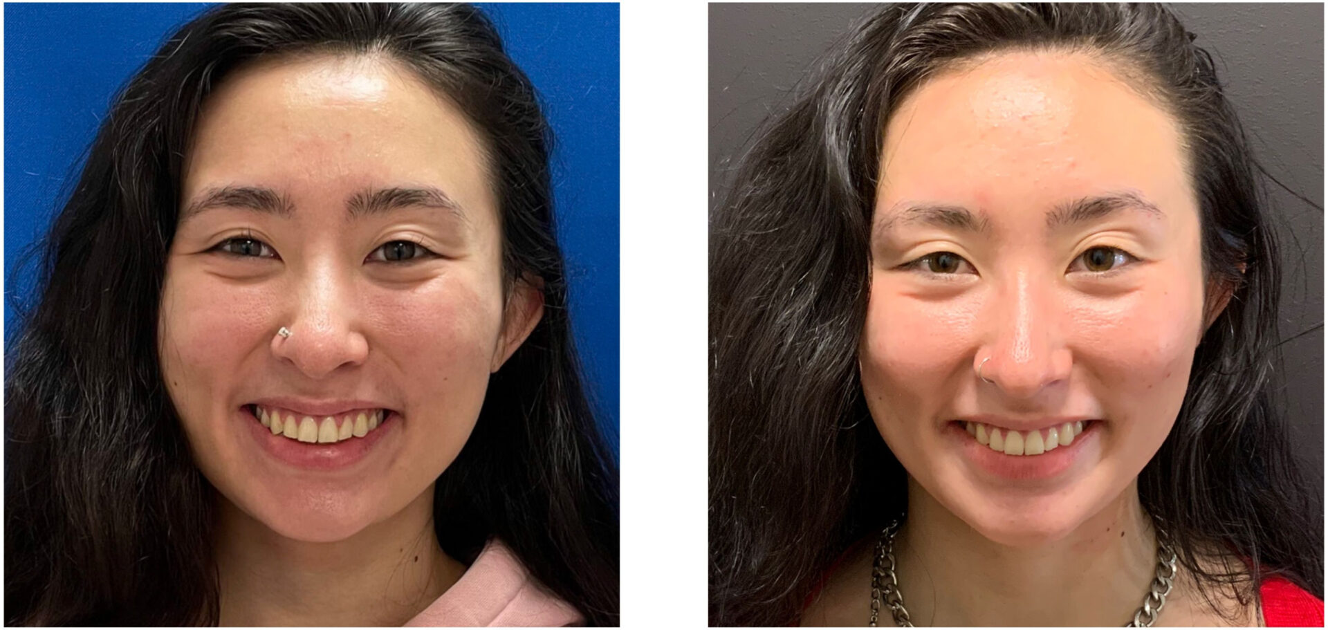 Buccal Fat - Before & After