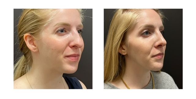 12a54e-e45-070d-5e73-cc3e60e8ef08_Leah_-_Jaw_surgery_Rhinoplasty