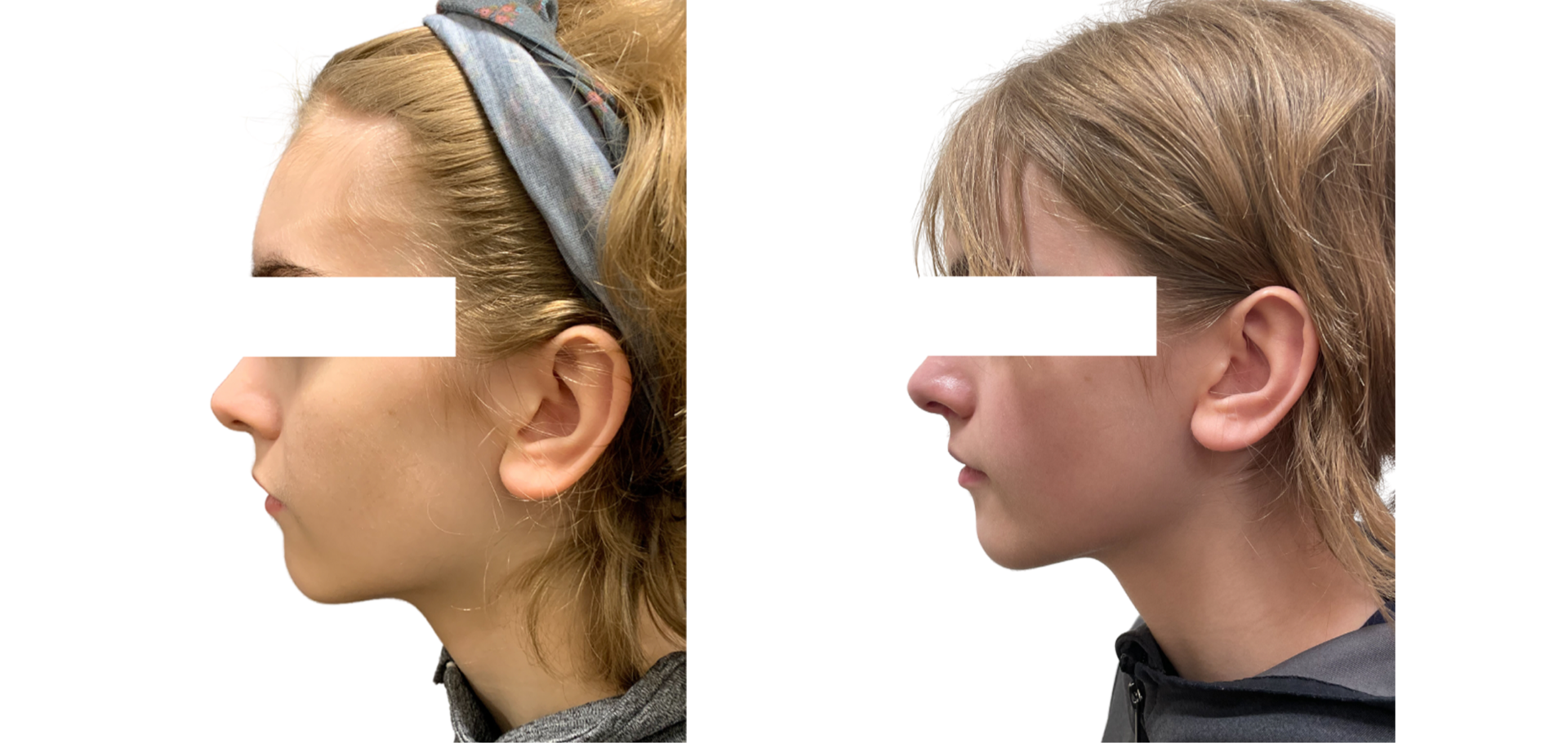 Genioplasty - Before & After