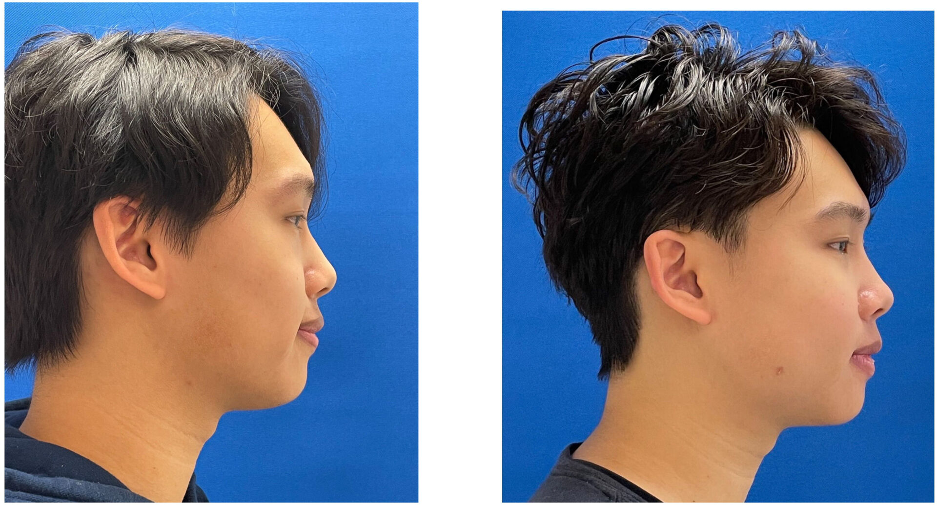 Facial Implants - Before & After