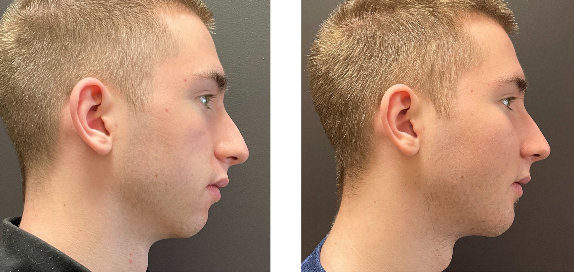 Genioplasty - Before & After