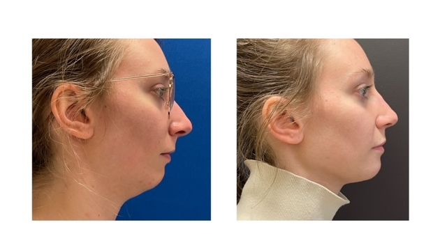 1a50863-cec1-cccc-1f48-e863f5bdd82c_Kaitlyn_-_Jaw_Surgery