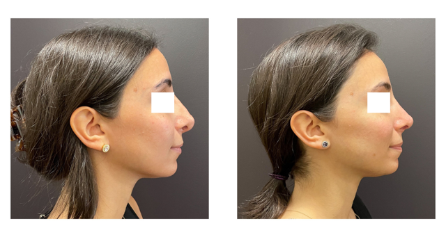 1bbff7-77e-02b3-1c7a-3b172e467bc_Lucy_-_Rhinoplasty_Revision_1_