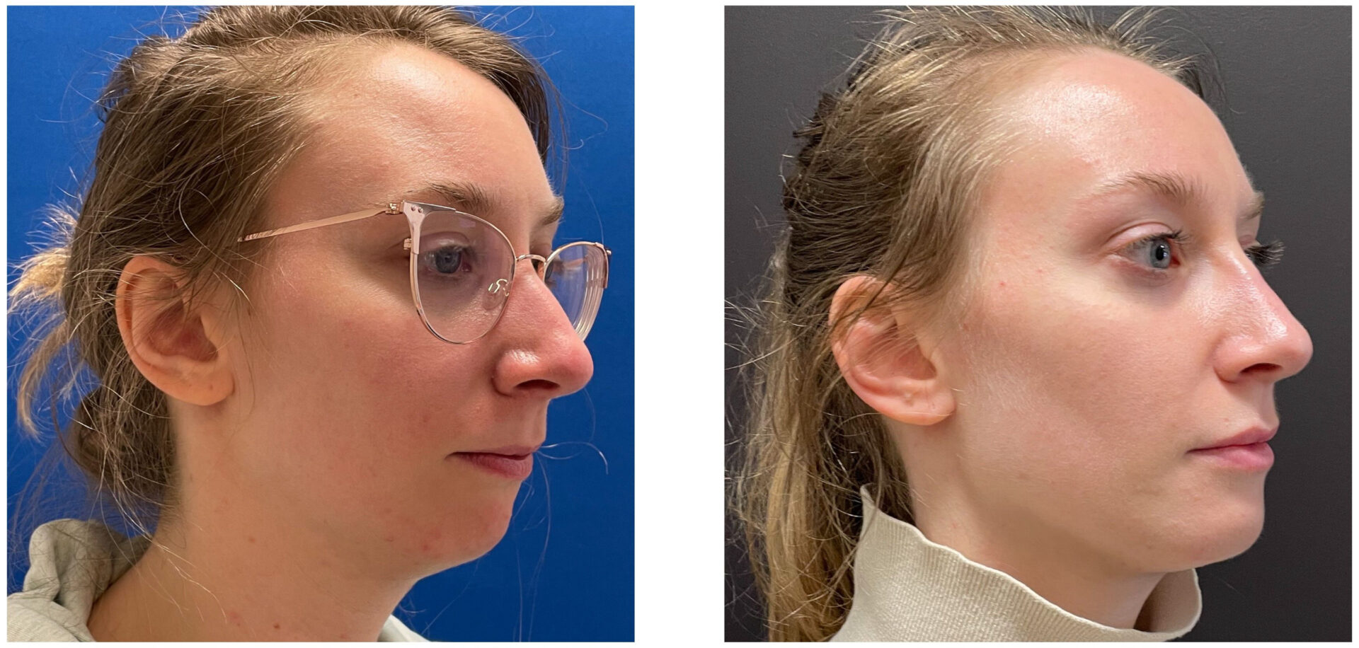 Jaw Surgery - Before & After