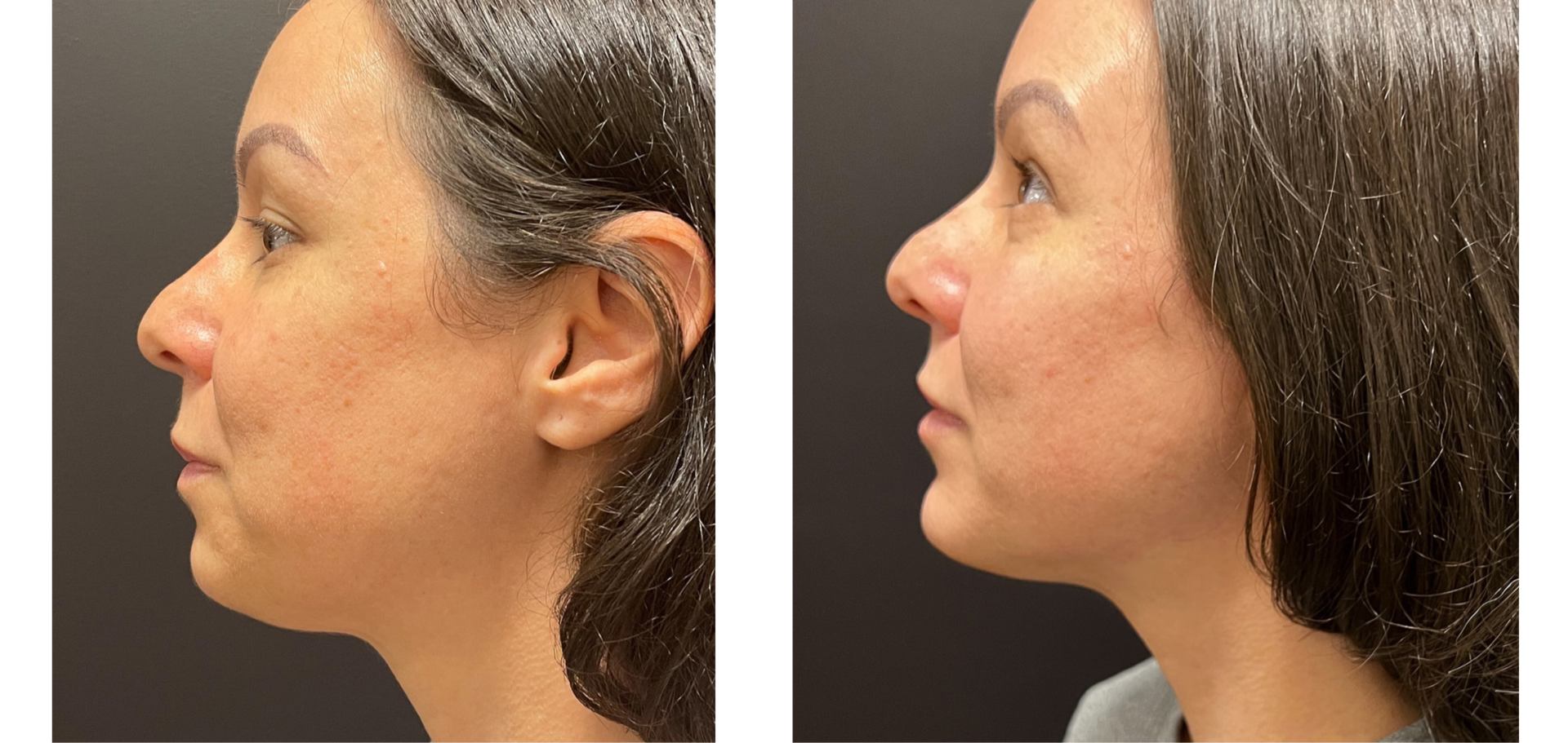 Genioplasty - Before & After