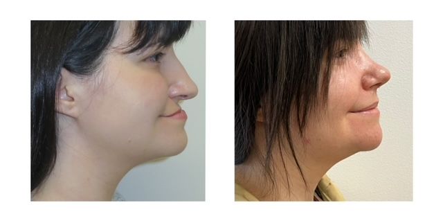 275c688-dcc5-7b8a-2714-a2306bbce30d_Elizabeth_-_Jaw_Surgery