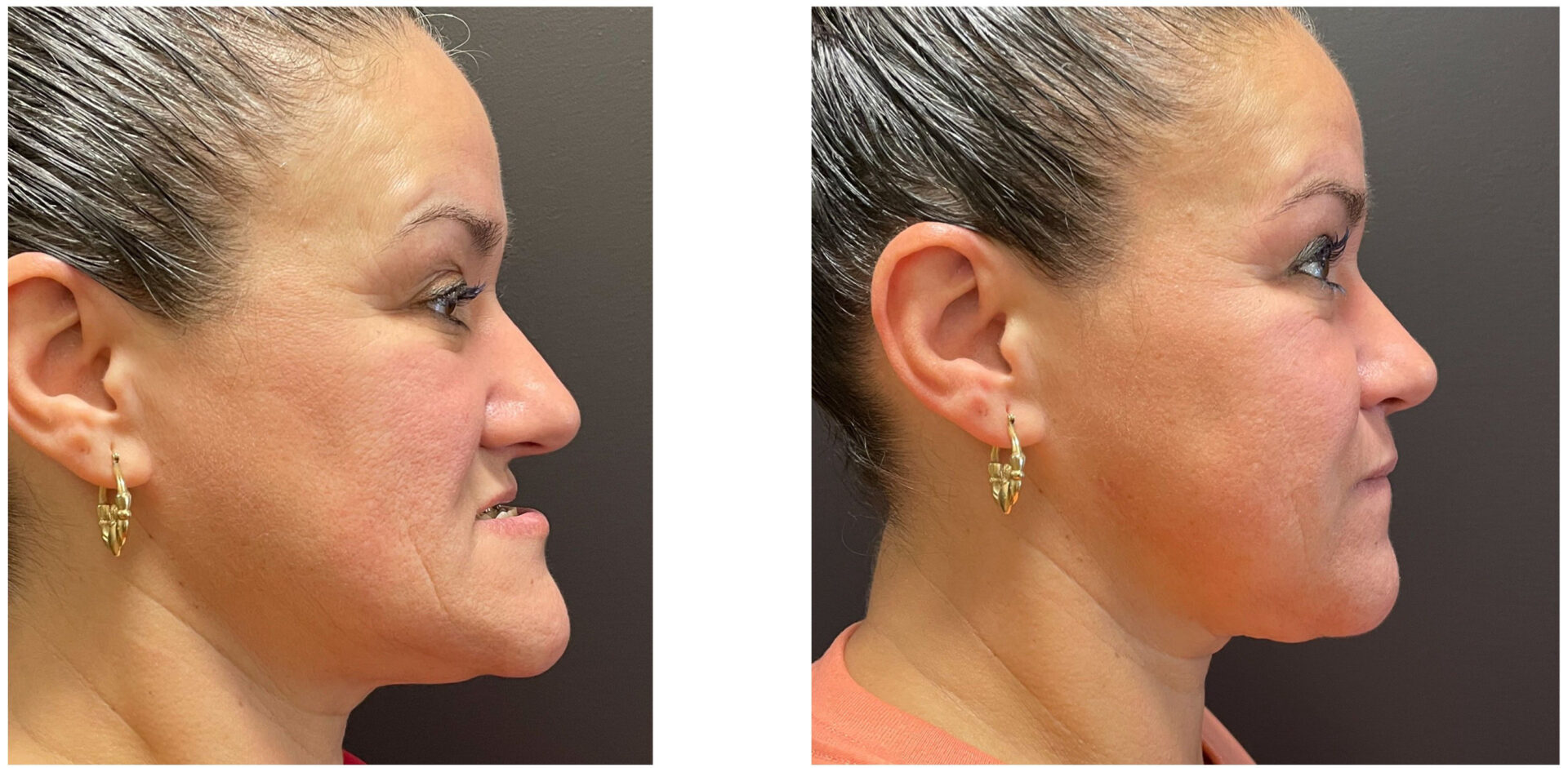 Jaw Surgery - Before & After