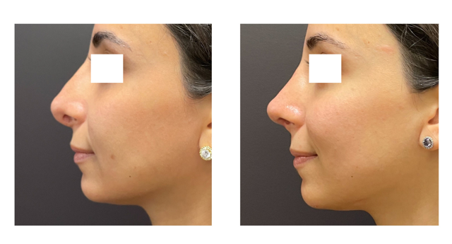 2dbe6c-ad24-8c07-01fa-5bbb38c8020_Lucy_-_Rhinoplasty_Revision