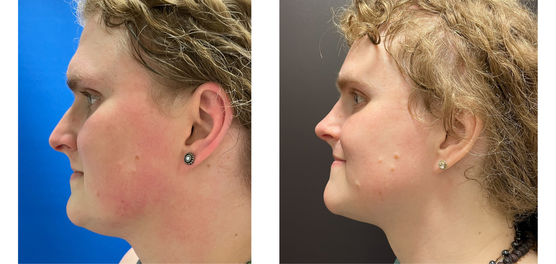 Facial Feminization Surgery (FFS) - Before & After