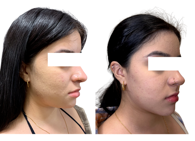 40c2b55-55f6-6588-7e8-08eda114fa5_Jemima_-_Genioplasty_1_