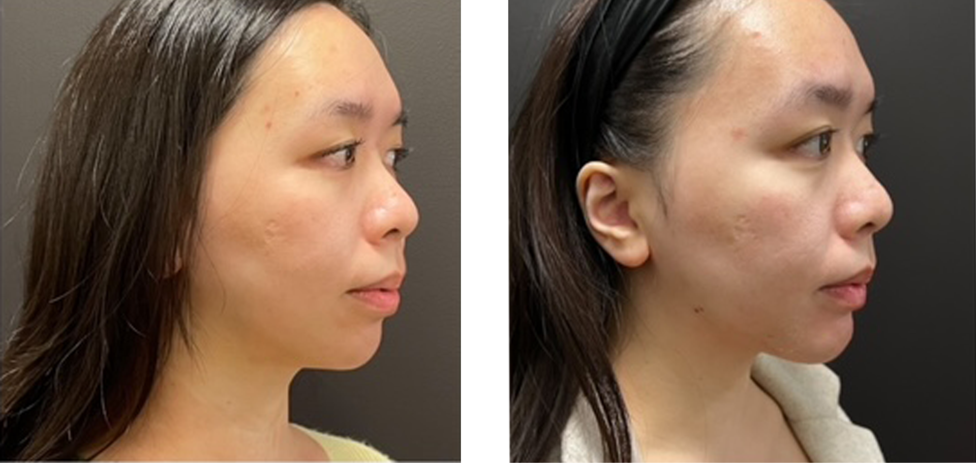 Genioplasty - Before & After