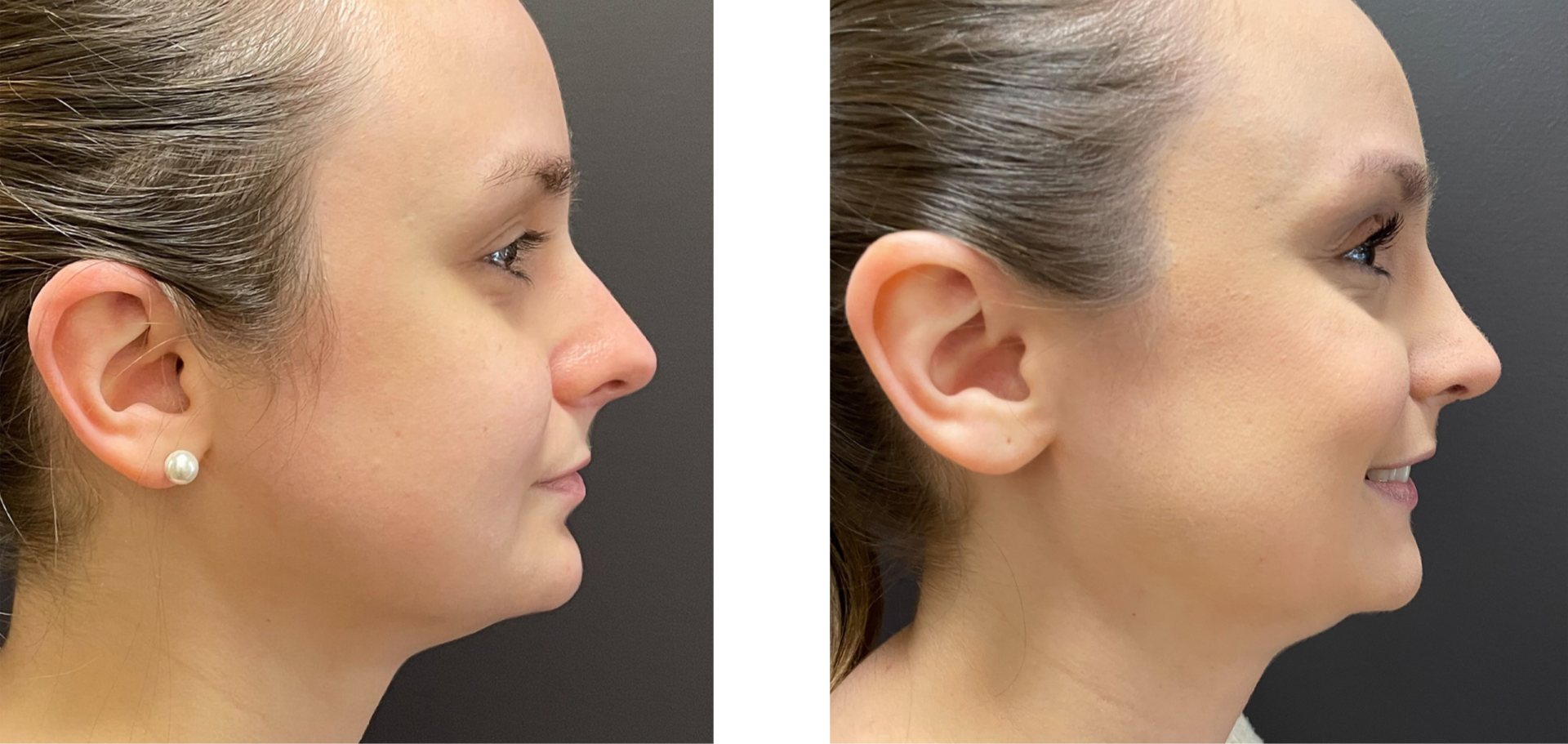 Cosmetic Rhinoplasty - Before & After