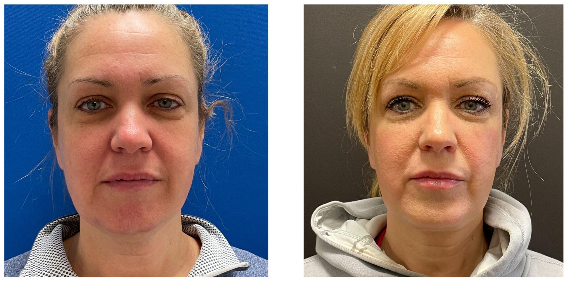 Facelift - Before & After