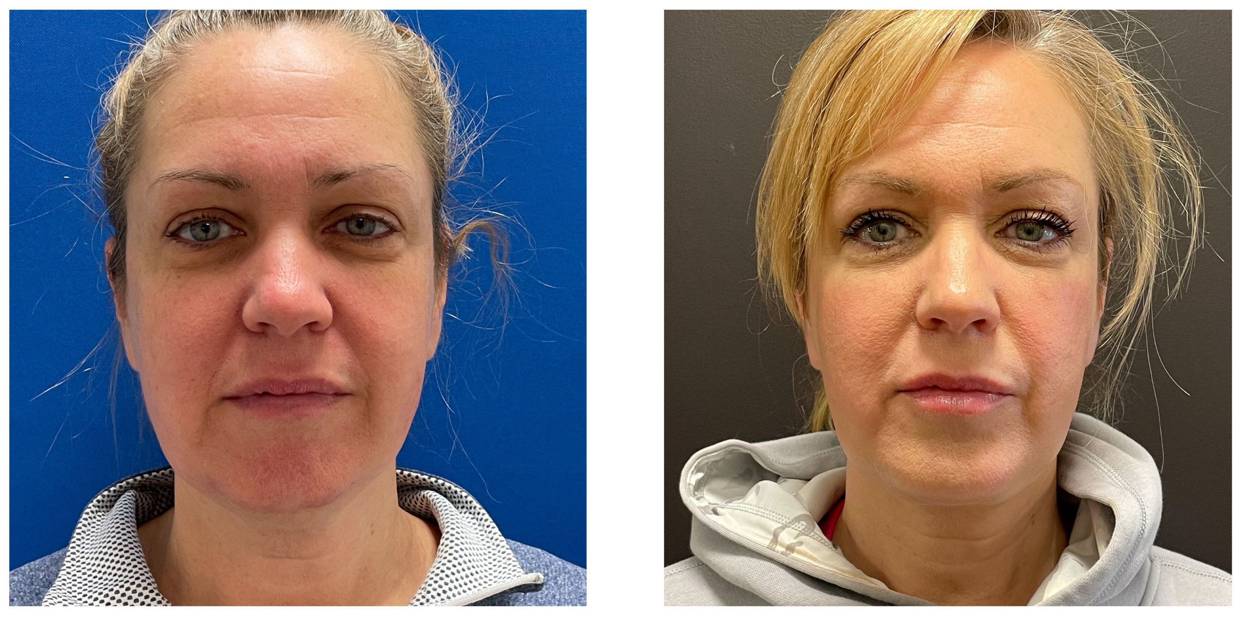 52a2550-dff3-6e4d-ffd3-42c3c40630c1_Bonnie_-_Facelift