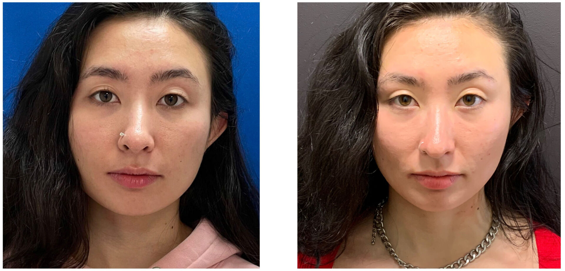 Buccal Fat - Before & After