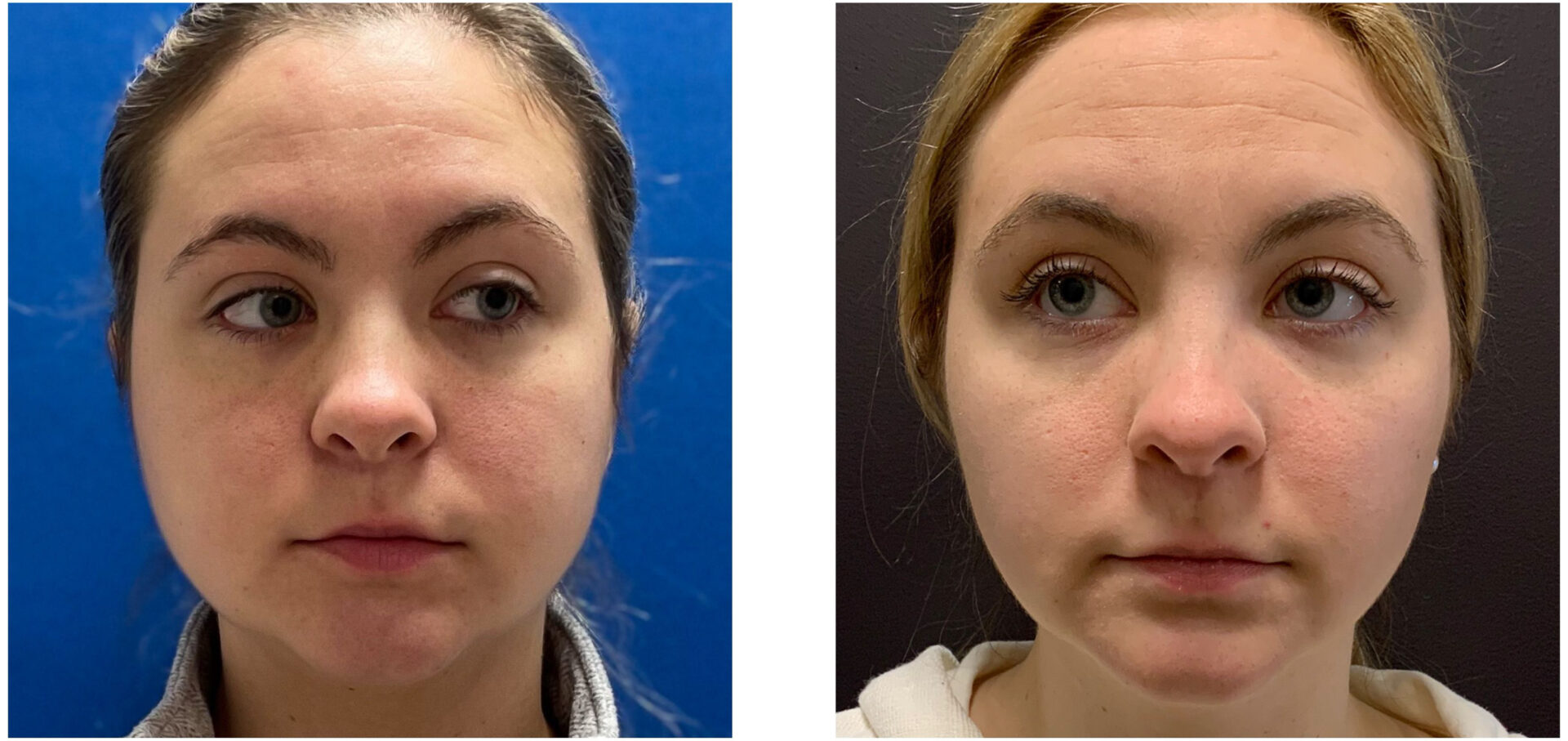 Buccal Fat - Before & After