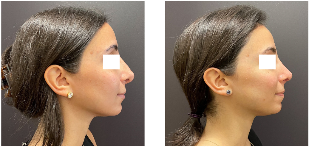 638f2ec-5ac0-3171-3-cf663f6fc0e4_Lucy_-_Rhinoplasty_Revision_1_