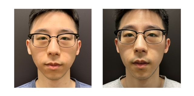 67707b7-8558-06c-30cd-757e0d435b5_Chris_-_Genioplasty