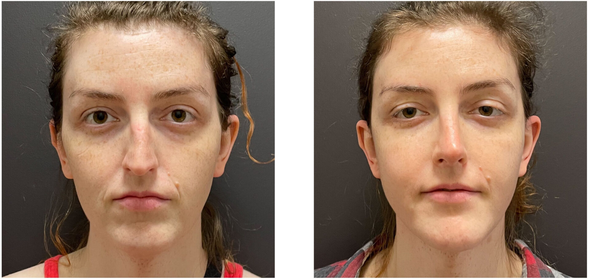 Facial Feminization Surgery (FFS) - Before & After