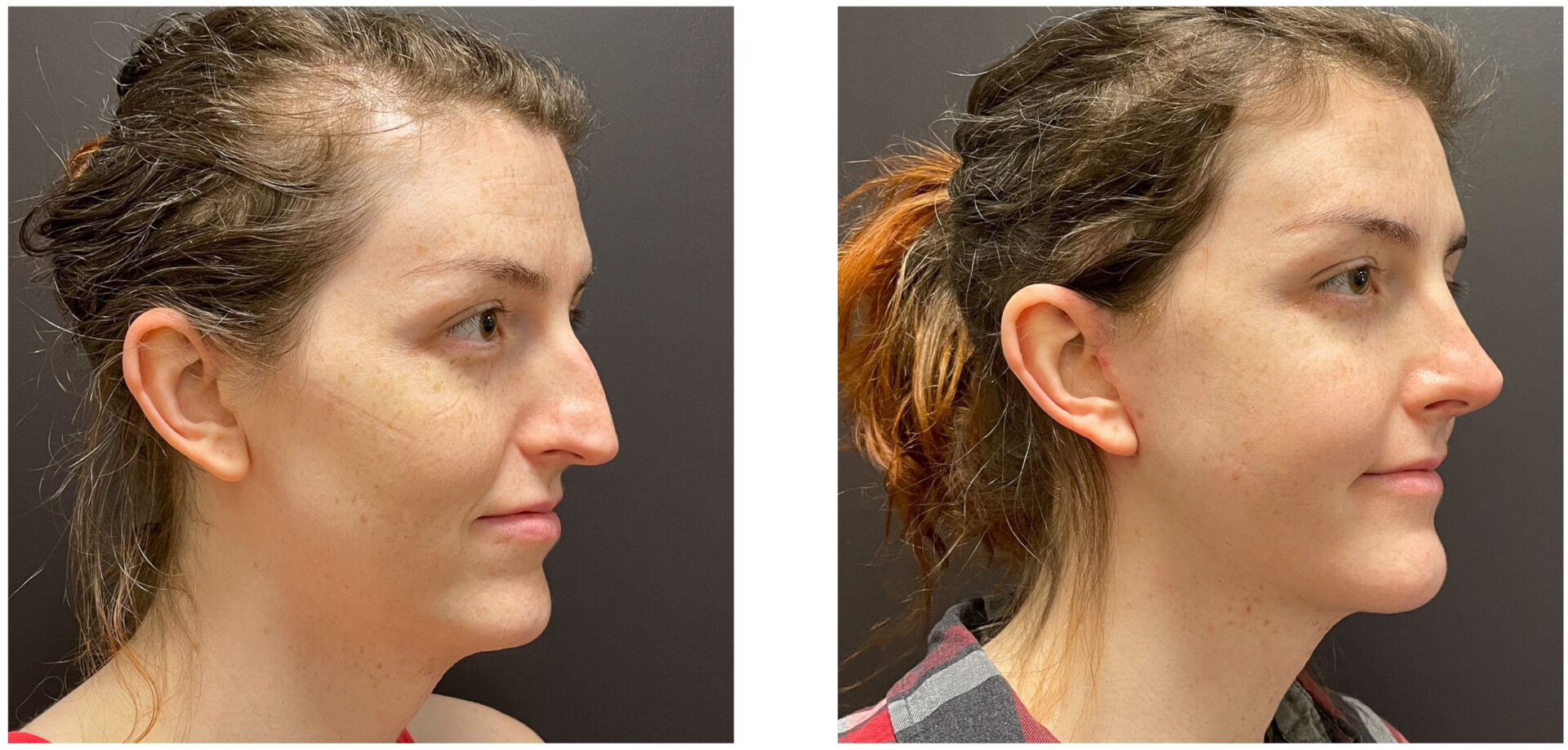 Facial Feminization Surgery (FFS) - Before & After