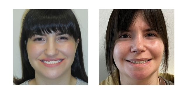 72a5587-5ce8-df87-01f2-f81aa6163ed6_Elizabeth_-_Jaw_Surgery_1_