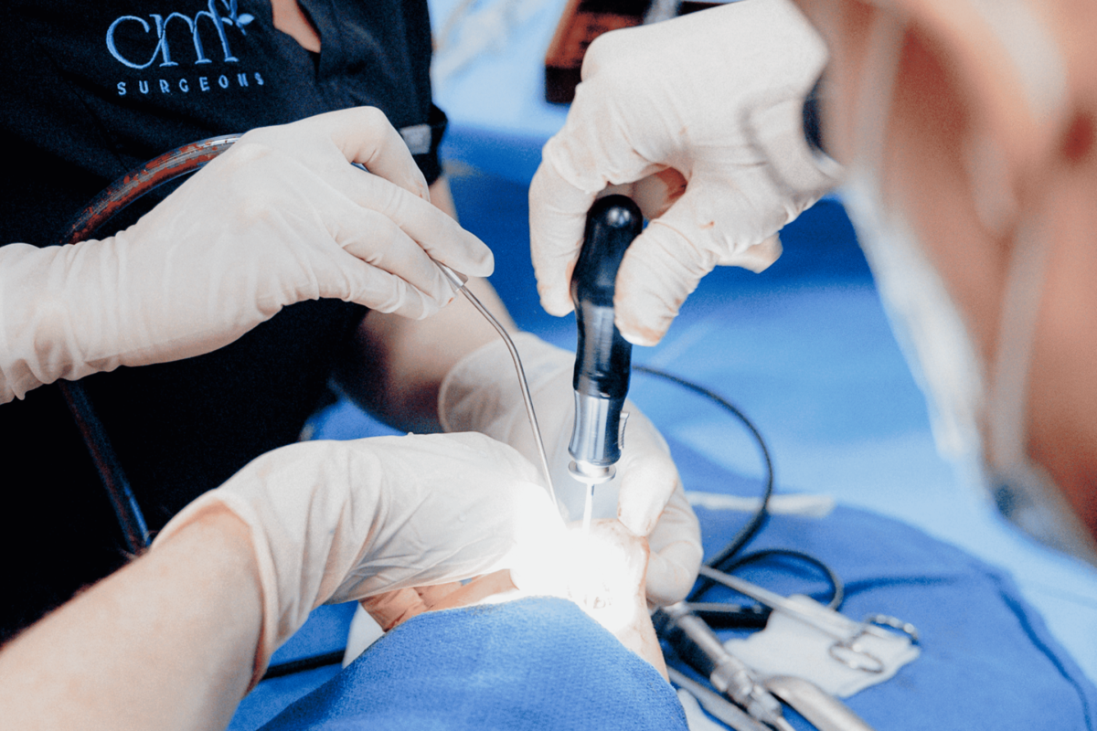 CMF surgeon using a surgical drill during a procedure, assisted by team members under bright lighting with instruments on a sterile blue drape.