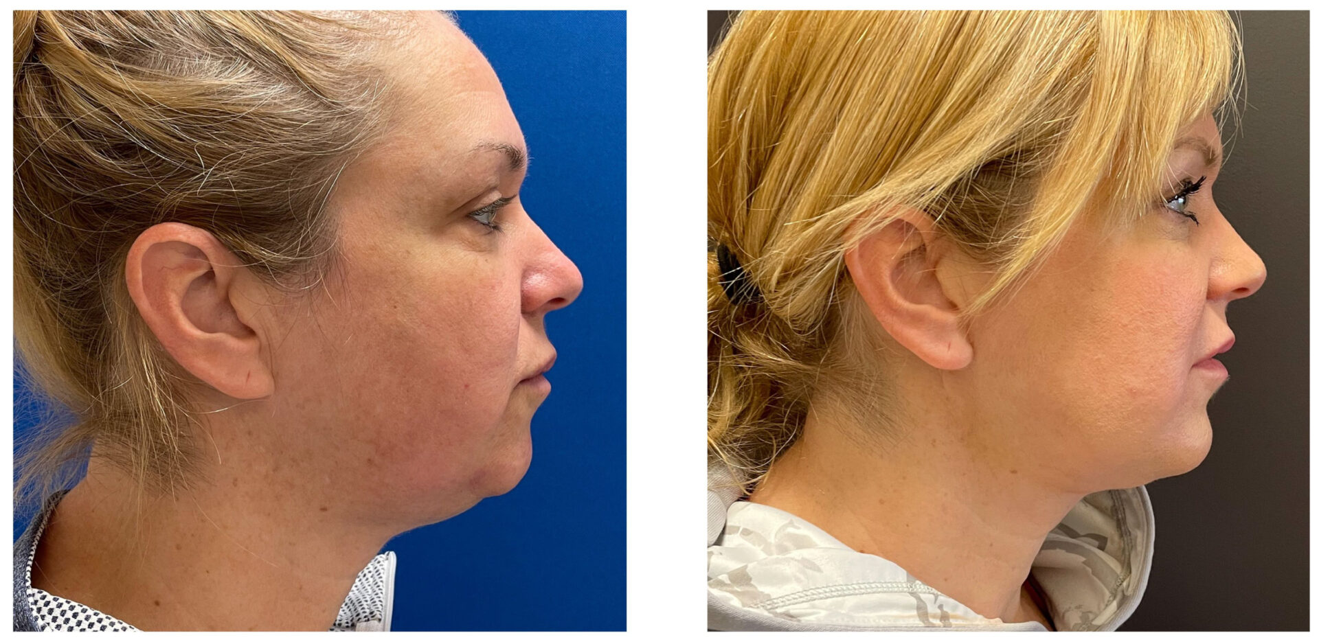 Facelift - Before & After