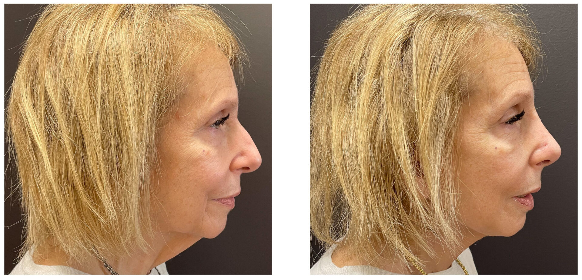 Facelift - Before & After