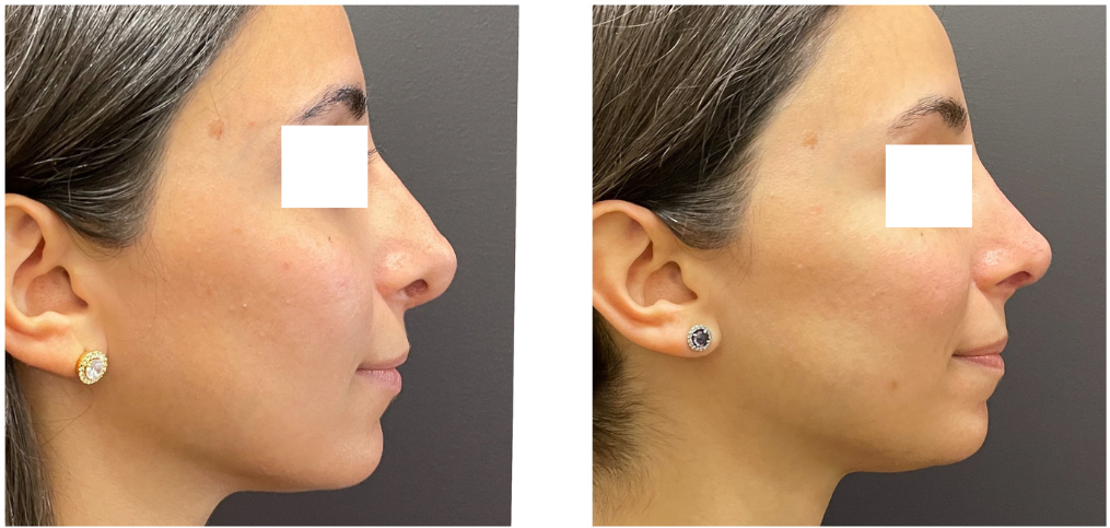 87fd6a6-dcd8-a462-65d6-00b013e8764_Lucy_-_Rhinoplasty_Revision_2_