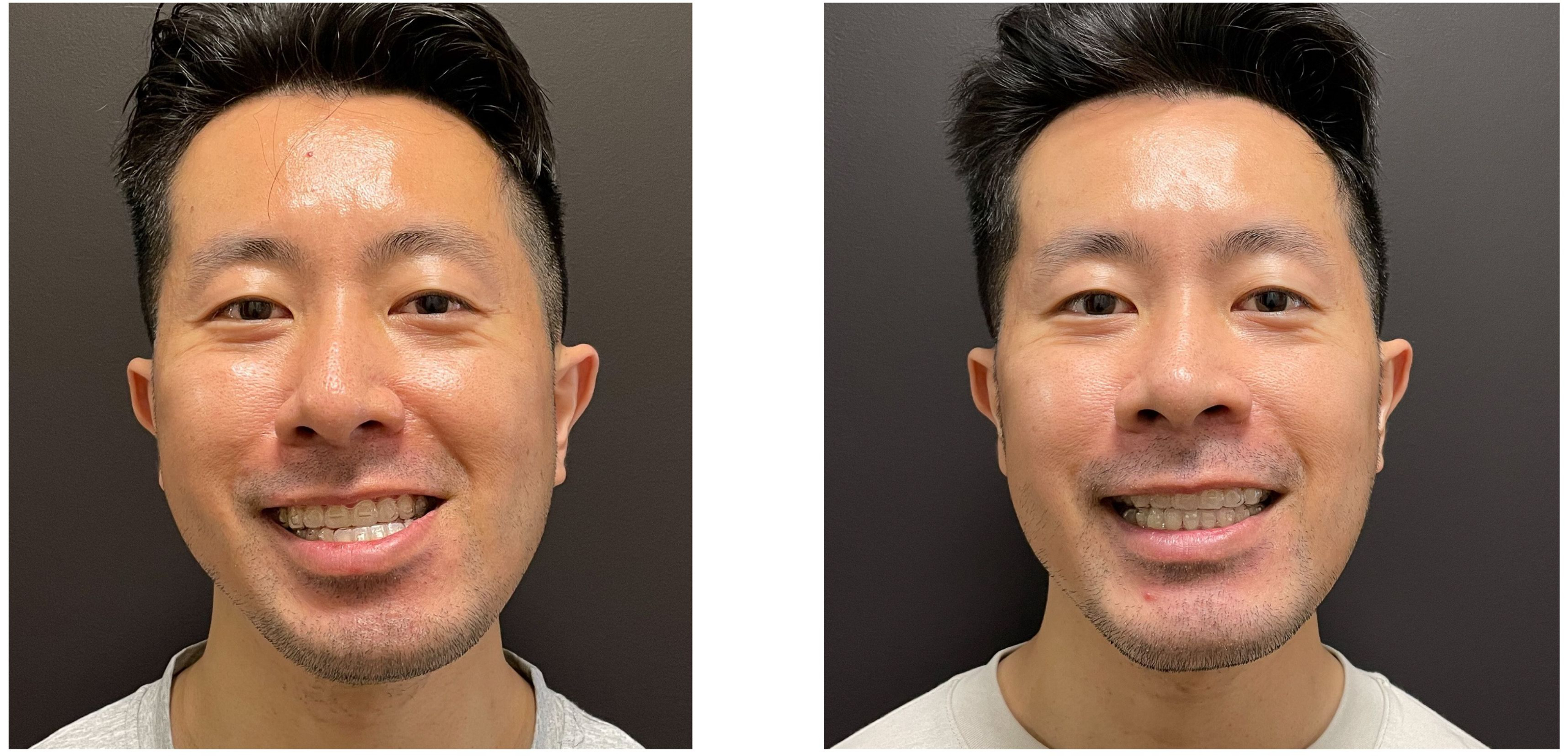 8da4721-468e-32dd-d1c-3fe1b853b_Peter_-_Jaw_Surgery