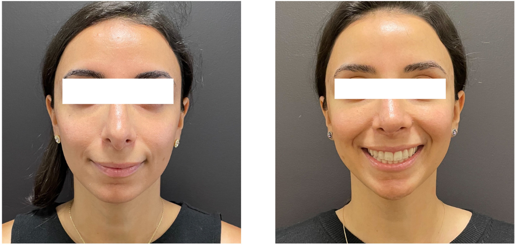 aa8d4-d735-5c8-e34-7f2c5412340_Lucy_-_Rhinoplasty_Revision