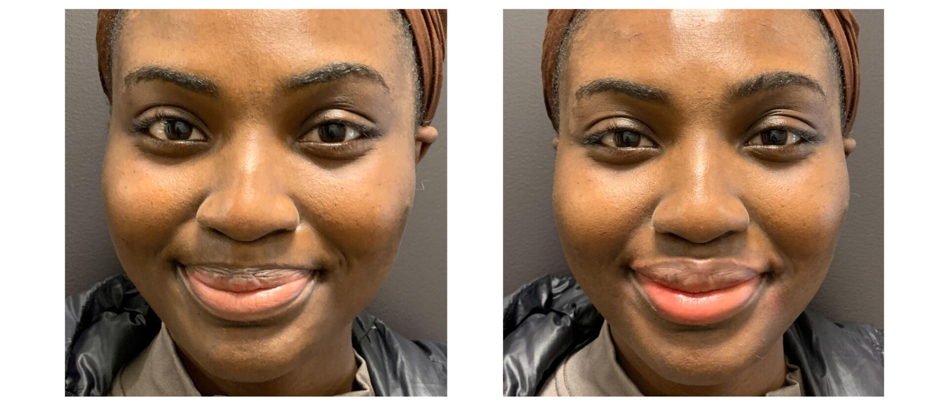 Botox/Xeomin - Before & After