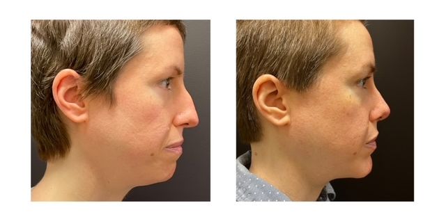 bd2641-fbbc-ffee-1057-ac45e4a75f_Anne_-_Rhinoplasty_Genioplasty