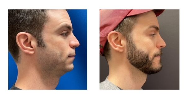 c36754c-44f8-cd57-8061-11a0008fbcc_Evan_-_Genioplasty_