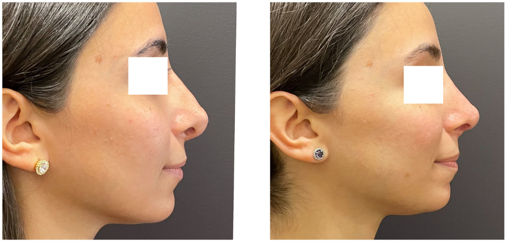 ccec4e8-7751-0a52-2d82-b04a77263d_Lucy_-_Rhinoplasty_Revision_2_
