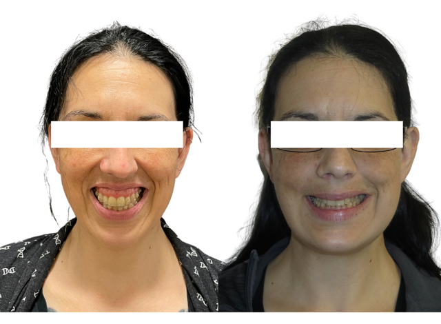 cd5b45-a6f-44e7-01f1-d88a6378cfc_Jocelyn_-_Jaw_Surgery_1_