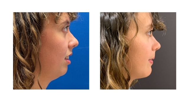 ce61e6-247-8c22-e7dc-6e6626f5a5_Paige_-_Jaw_Surgery