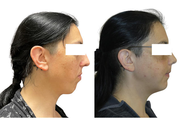 e212183-335-50f1-4de7-81b8af33ae0_Jocelyn_-_Jaw_Surgery