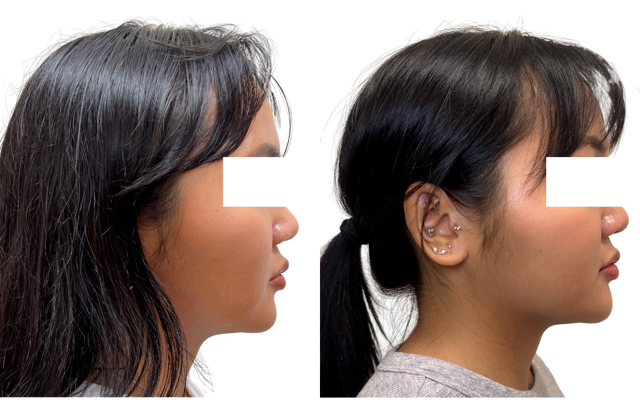 e365d4-c410-183-75ff-5f55c24448cf_Somontha_-_Genioplasty_w_JLC