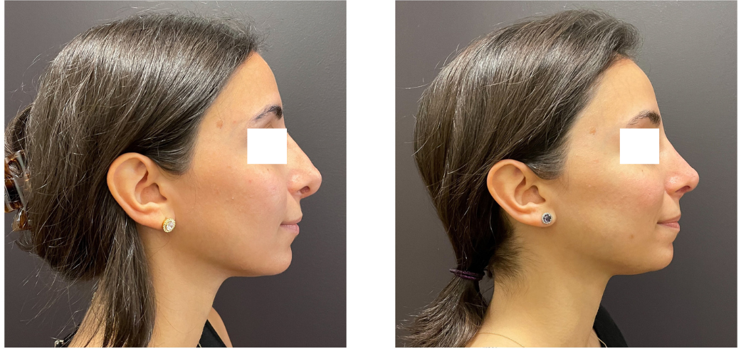ebfd86-acbf-23b-7b88-f17ecc08e8a_Lucy_-_Rhinoplasty_Revision_1_