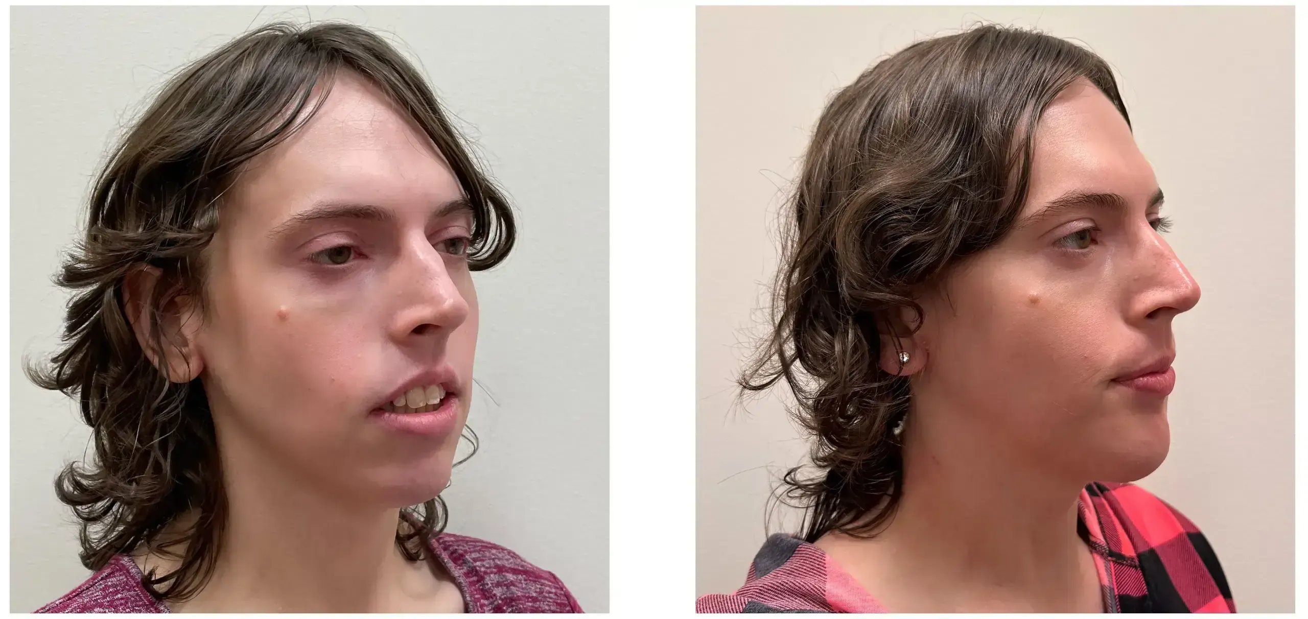 f13ad3-2edb-3072-7fb-3a46e60101f2_6b315d-Nicholas_Boldt_-_Genioplasty