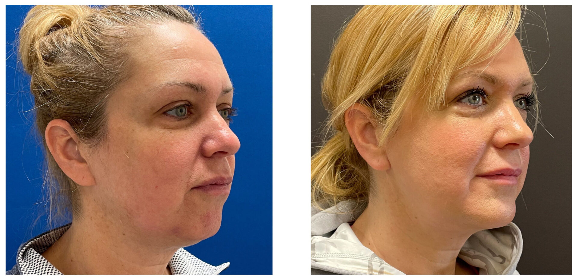 Facelift - Before & After