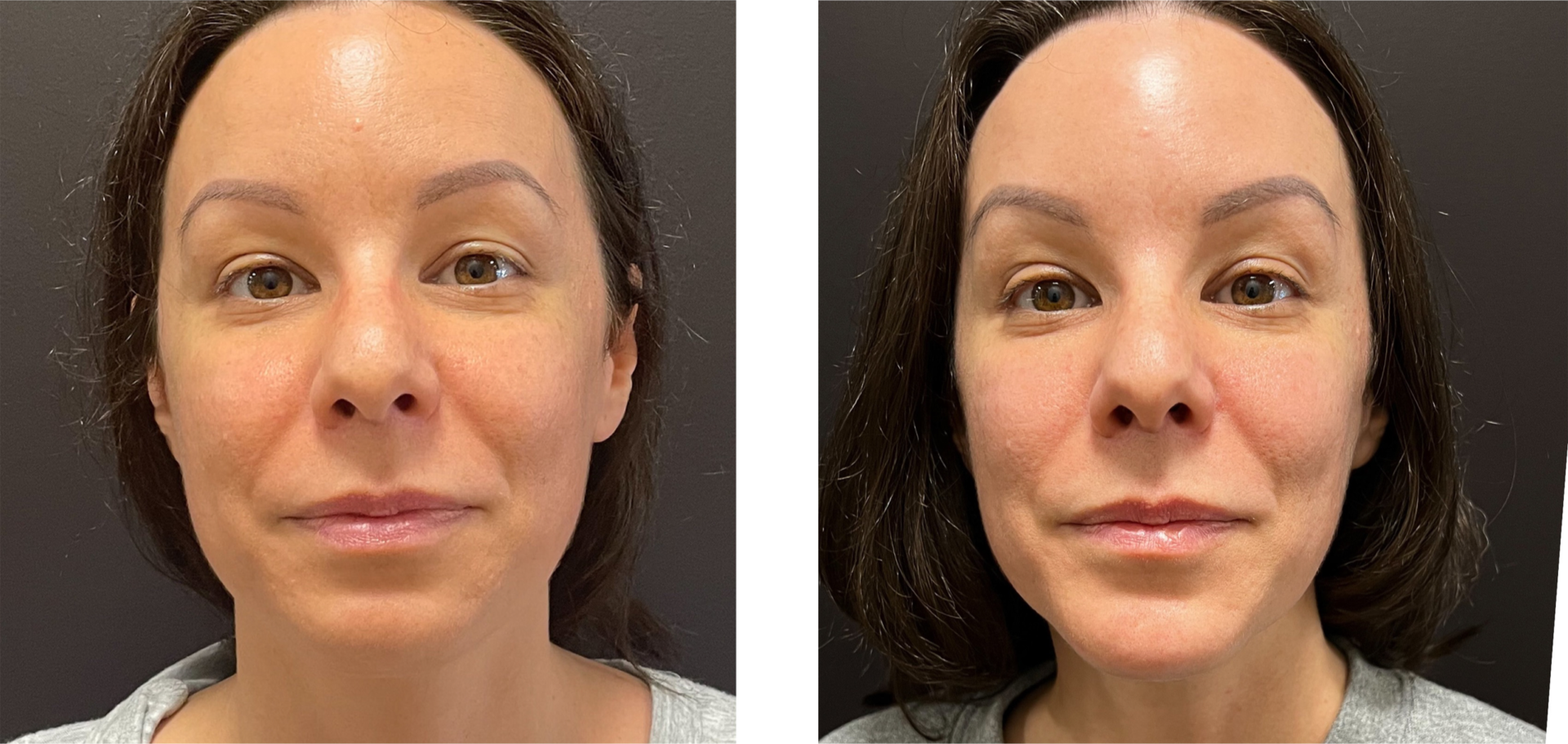 Genioplasty - Before & After