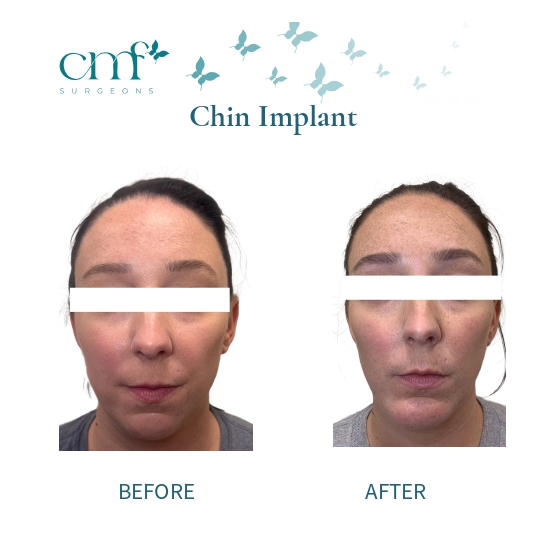 Before & After | Chin Implants