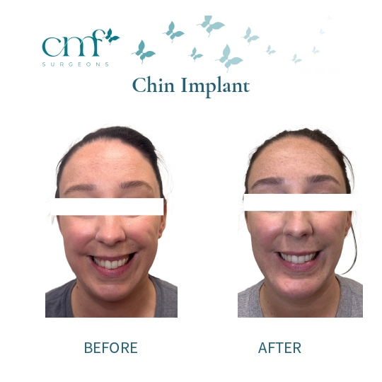 Before & After | Chin Implants