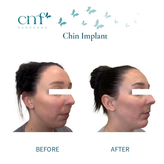 Before & After | Chin Implants