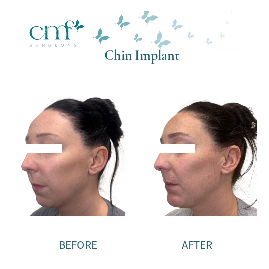 Before & After | Chin Implants